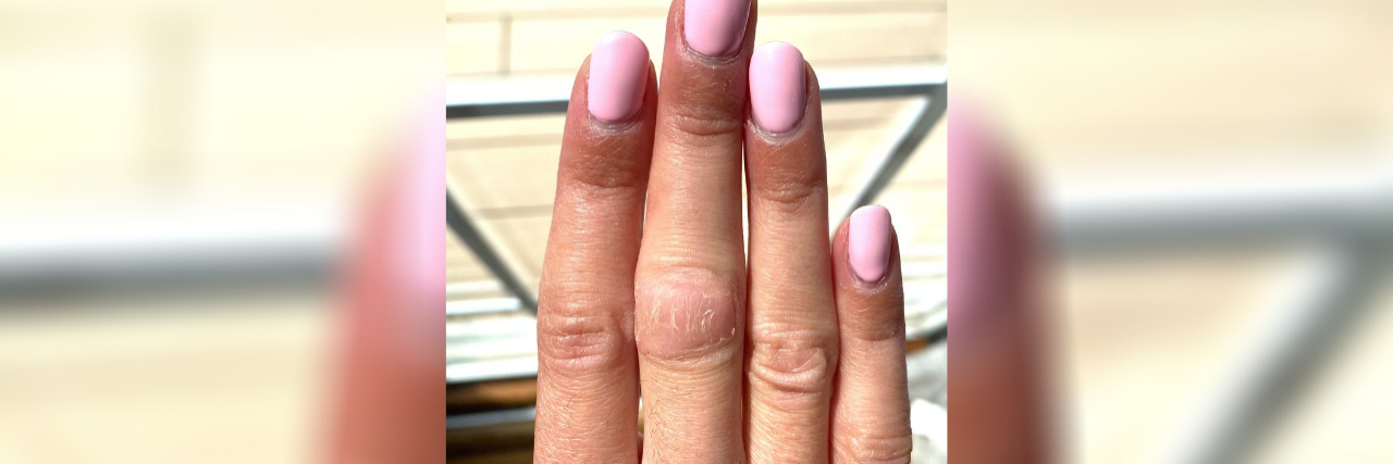 OCD Makes Me Pick the Skin on My Fingers and Knuckle photo of woman's nails with injured knuckle on her index finger
