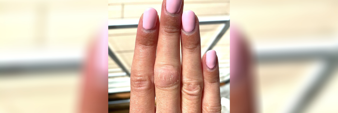 photo of woman's nails with injured knuckle on her index finger