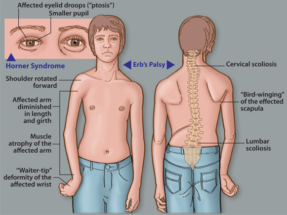This is a diagram of how Erb's palsy, a type of obstetric brachial plexus palsy can impact a person as they grow. The similarities whether intended or not to Michael's character in the Lucifer show, raise a lot of questions about Michael's background and what story they are trying to tell by giving Michael a limb difference. 