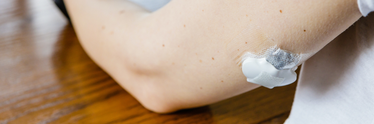 Broken Insulin Pump? Here's How to Use Your Back-Up. woman checking glucose level and dosing insulin using insulin pump and remote sensor on her hand, focus on foreground
