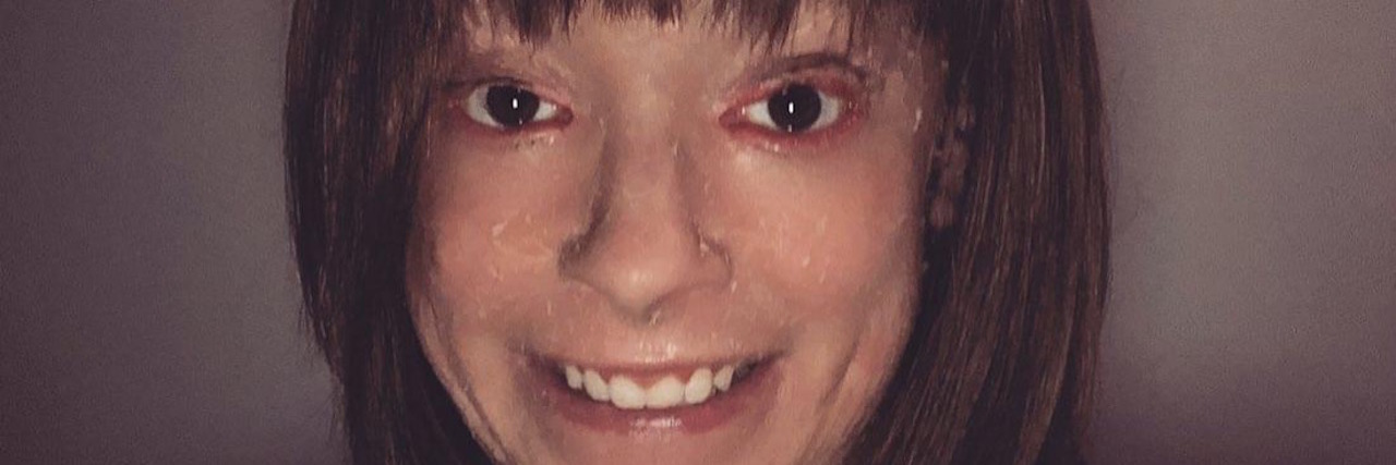 Hearing Comments on Your Appearance With Lamellar Ichthyosis