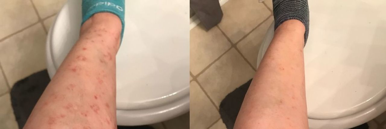 6 Tips for Managing Pityriasis Lichenoides Chronica