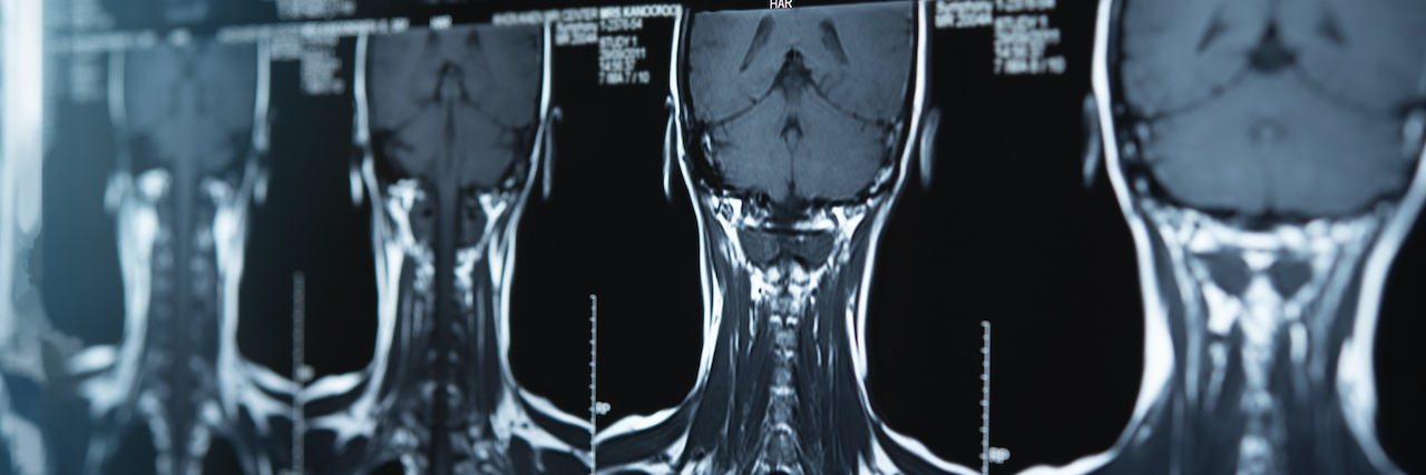 X-Ray Results: Child With SEPN1/SELENON-Related Myopathy mri ct scan for cervical spine injury of patient.