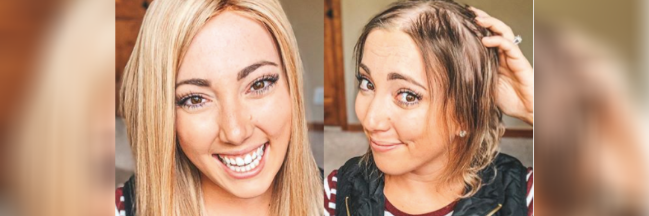 Meet the Woman Normalizing Hair Loss on TikTok Side by side of a woman with shoulder-length blonde hair (a wig) and her without her wig