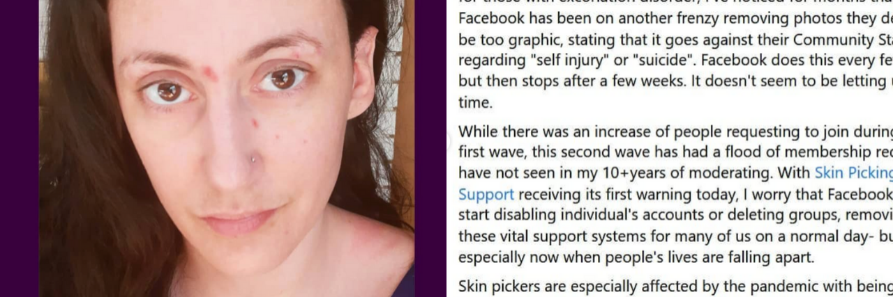 Facebook Is Deleting Photos From People With Dermatillomania on the left: a photo of the author with scars on her face. On the right: a Facebook post