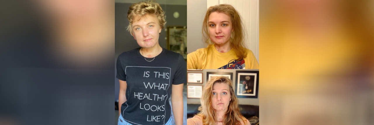 Reflections on Losing My Hair Due to Rare Disease Treatment Three images of the contributor: 1 with short, stylish hair; 1 with her hair up and appearing to be thinning; and 1 with longer, wavy hair