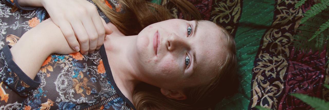 Body Positivity and Accepting My Hydrocephalus Surgery Scars photo of woman with her hands crossed on her chest, lying on the ground in a forest surrounded by ferns and looking into camera
