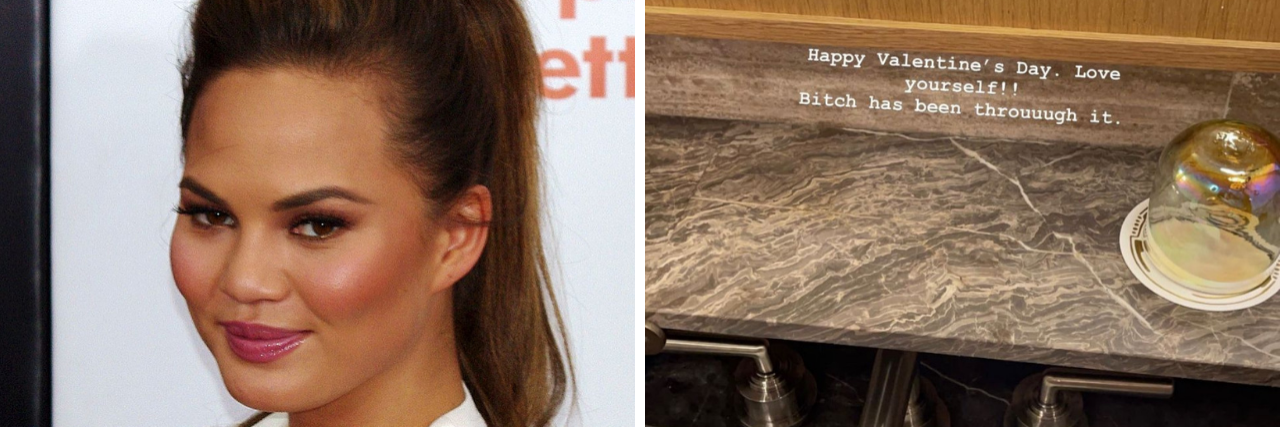 Chrissy Teigen Shares Photo Showing Endometriosis Surgery Scars Chrissy Teigen Endo Surgery Scars