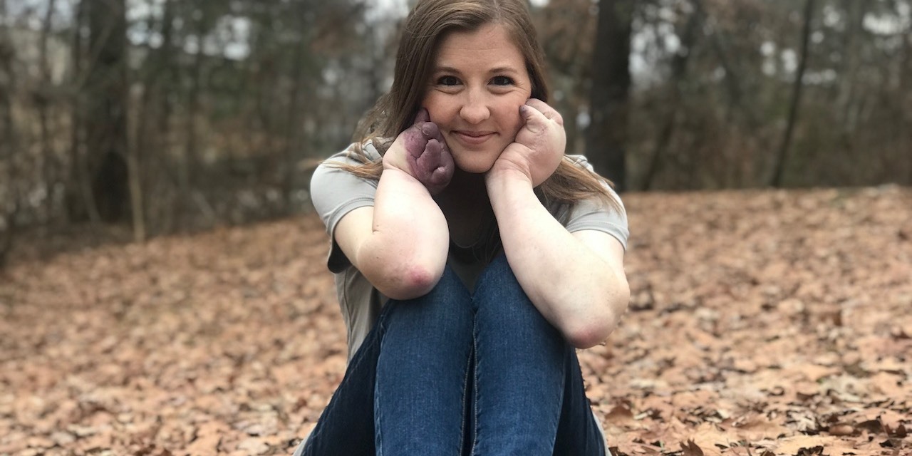 CLOVES Syndrome Celebrating Rare Disease Day