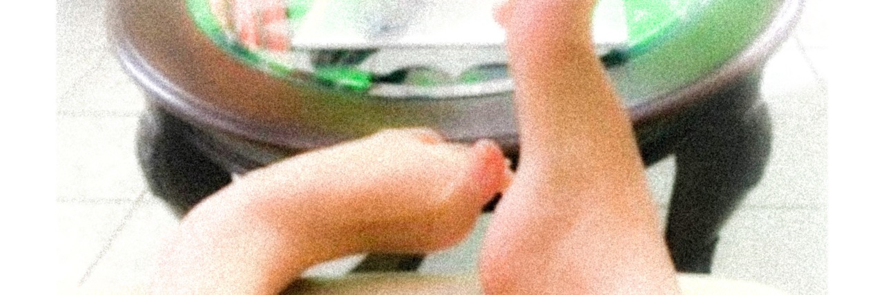 How Dystonia Affects My Life Jennifer's feet showing symptoms of dystonia.