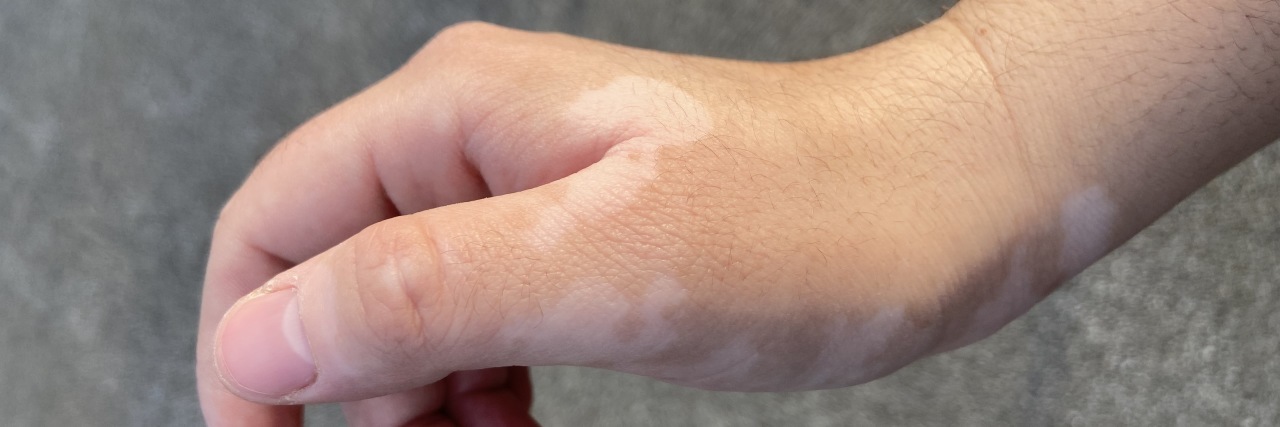 Why Spring Makes Me Feel Beautiful as a Person With Vitiligo