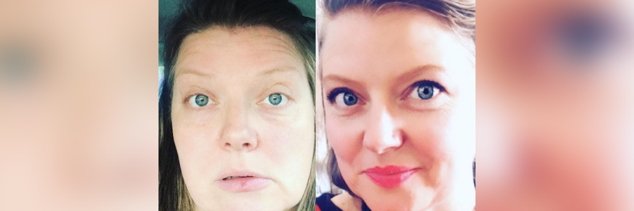 Finding Out My Stroke Symptoms Were Really Hemiplegic Migraine Two photos of contributor side-by-side