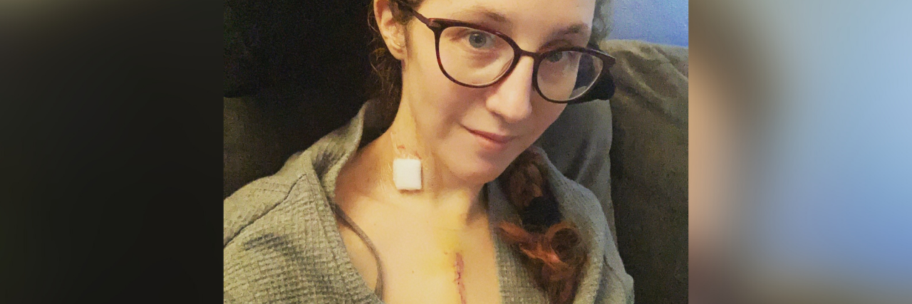 Open Heart Surgery Recovery: 11 Things No One Warns You About Author Amelia Blackwater with the top of her chest showing a long scar from her open heart surgery. She has another bandage on her neck, and she's sitting on a sofa and smiling in her recovery.