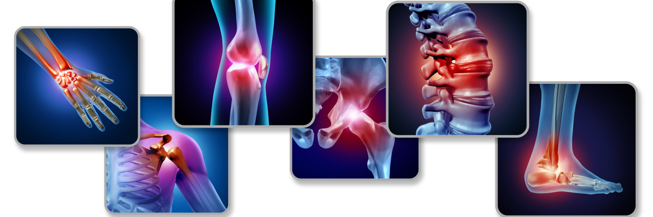 Getting a New Rheumatoid Arthritis Diagnosis: 13 Things to Know X-rays of joints showing painful areas.