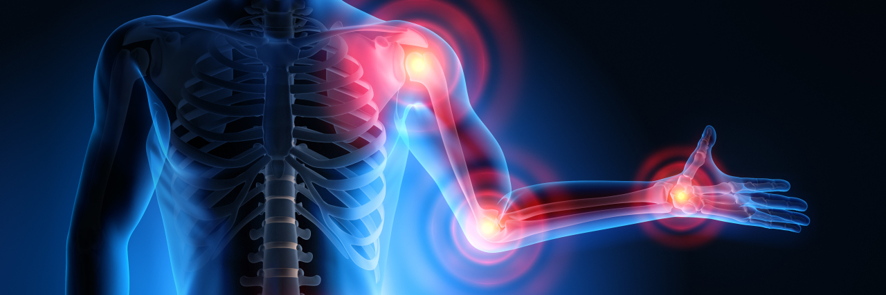 AskMe: We Asked an Expert Your Questions About Rheumatoid Arthritis Diagram of how rheumatoid arthritis affects the joints.