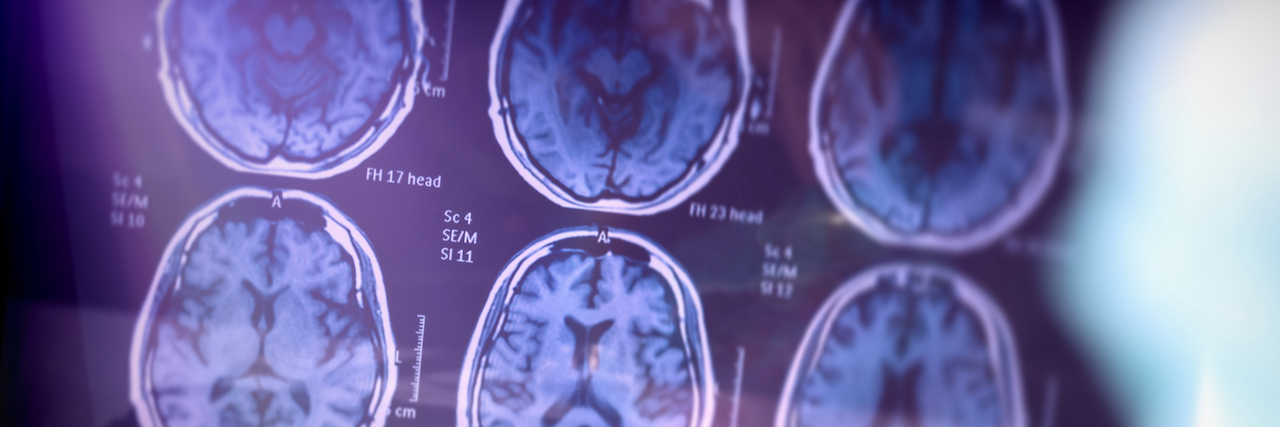 The Brain Science That Explains Anorexia Brain scans