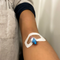What It Was Like to Get My First Infusion Treatment for M.E. Woman's arm with IV port.