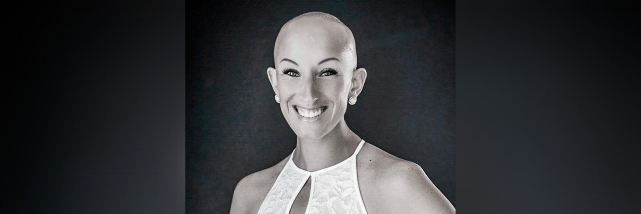 Lindsay, a woman who is bald due to alopecia.