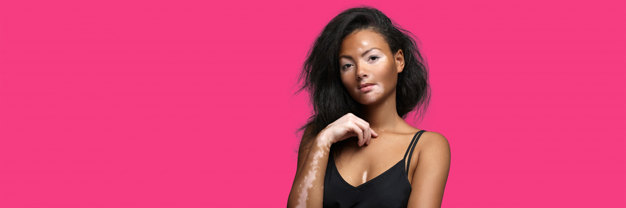Vitiligo FAQ: What You Need to Know About This Skin Condition Beautiful African woman with vitiligo.