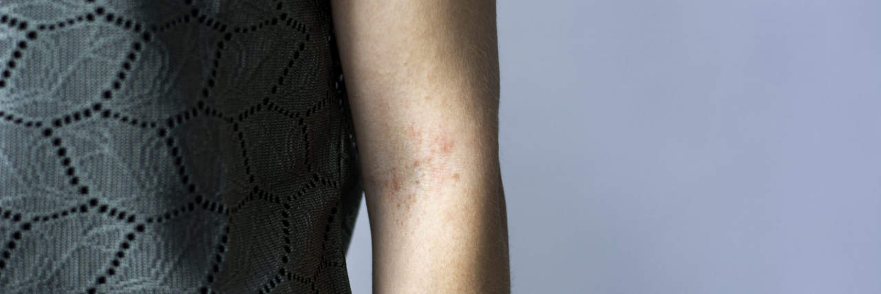 What is Alagille Syndrome With Cholestatic Pruritus?