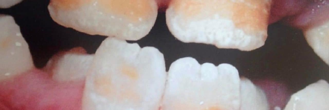 Why Rare Dental Diseases Can Be Disabilities Kellyann's teeth before caps