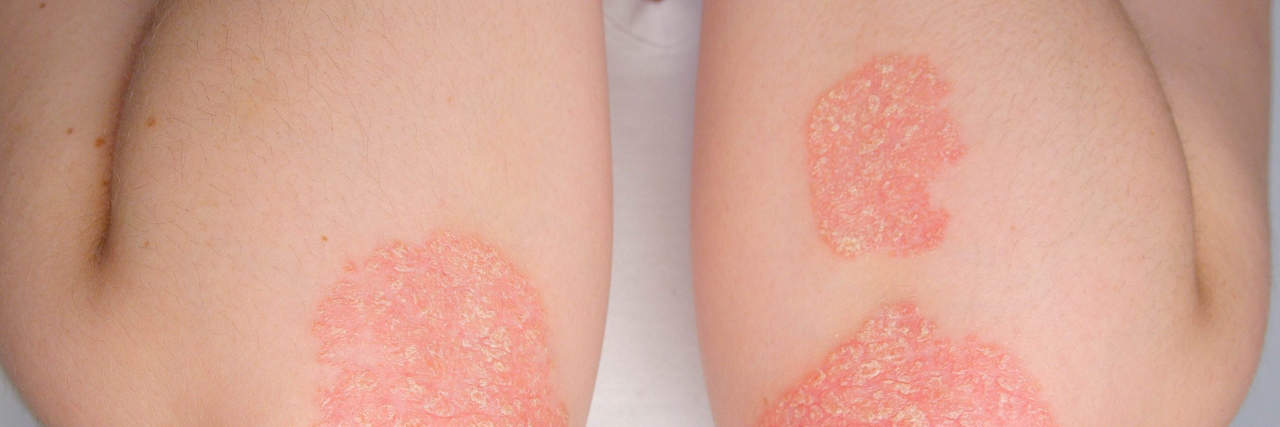 A Guide to Psoriasis: What You Should Know About This Skin Condition Psoriasis guide: Red patches on skin of arms and elbows.