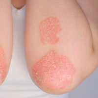 Psoriasis guide: Red patches on skin of arms and elbows.