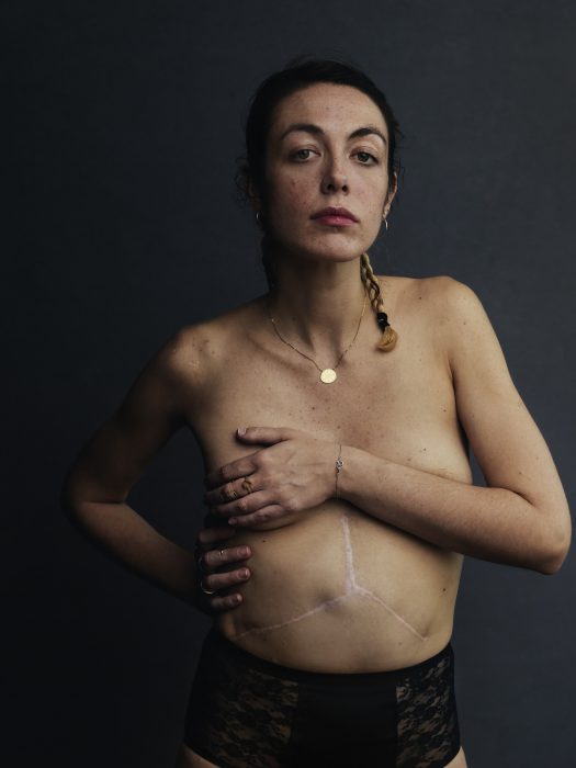 Photo of contributor holding her arm across her chest with her large transplant scar visible on her torso