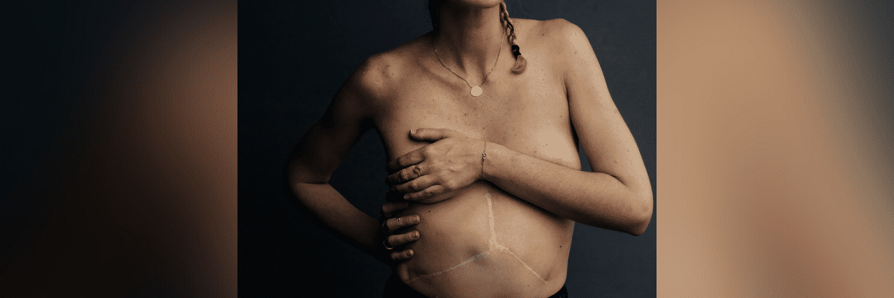 How I'm Finally Learning to Love My 'Mercedes-Benz' Transplant Scar Image of contributor holding her arm across her chest with large kidney transplant scar on her torso