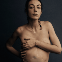 Image of contributor holding her arm across her chest with large kidney transplant scar on her torso