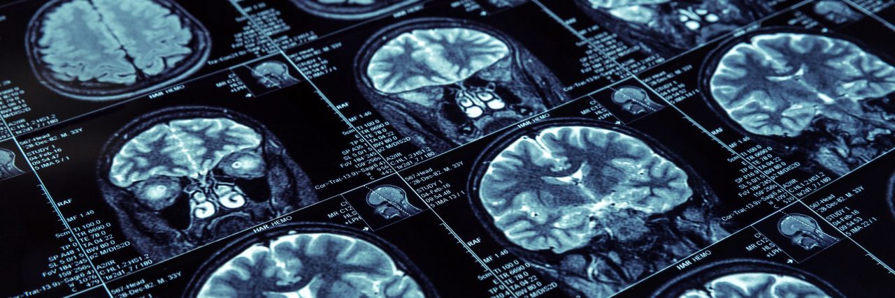 Closeup of X-ray photography of human brain