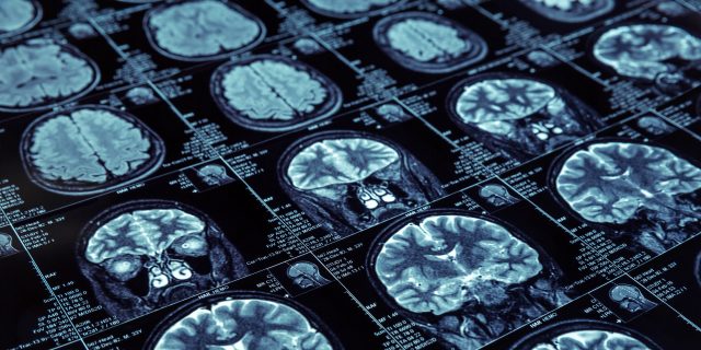 Closeup of X-ray photography of human brain