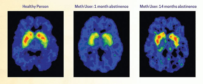 Brain MRI comparison to show addiction recovery from the Journal of Neuroscience
