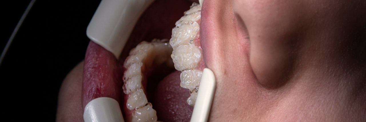 Close up of someone's teeth at the dentist