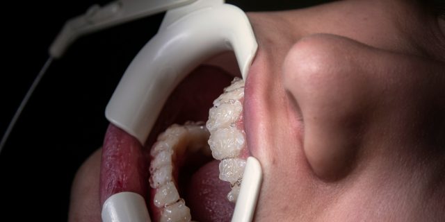 Close up of someone's teeth at the dentist