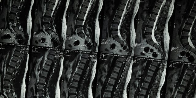 What Is Kyphoscoliosis? xrays of a spine