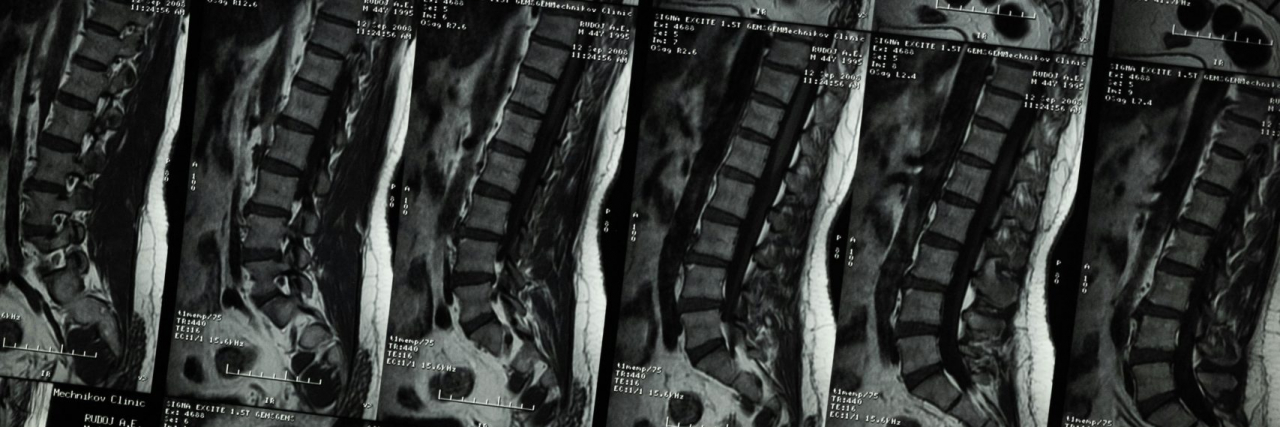 What Is Kyphoscoliosis? xrays of a spine