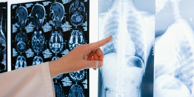 Situs Inversus: When the Body’s Map Is Reversed chest mri