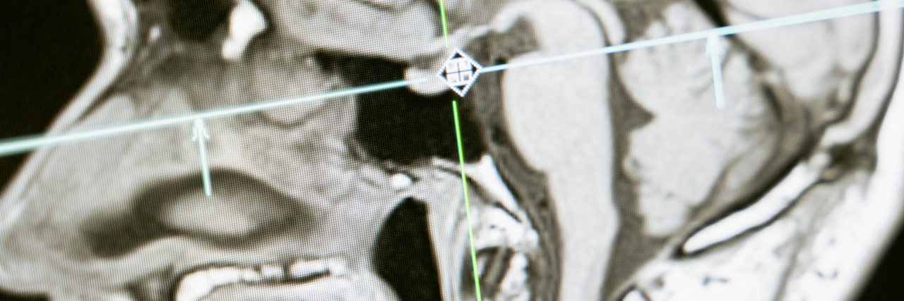 mri of the skull