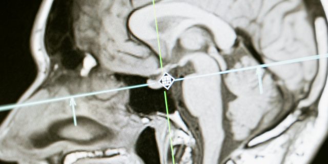 'Strange' Chiari Malformation Symptoms Most People Don't Know About mri of the skull