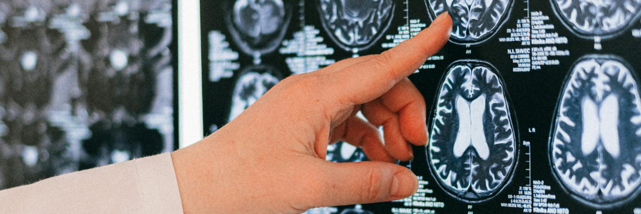 MS vs. Atherosclerosis doctor looking at brain scans of someone with MS